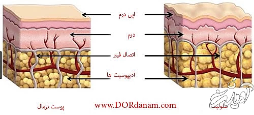 سلولیت